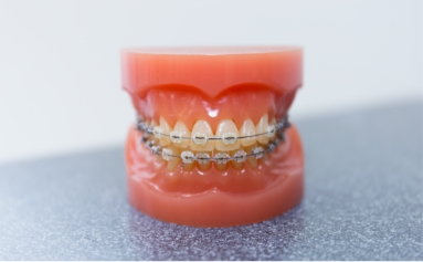 歯の表側につける装置