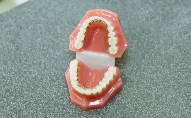 舌側（歯の裏側）につける装置
