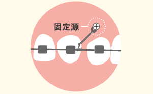 歯科矯正用アンカースクリューを固定源にする理由